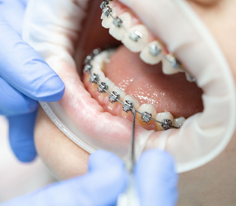 What to do during a dental emergency