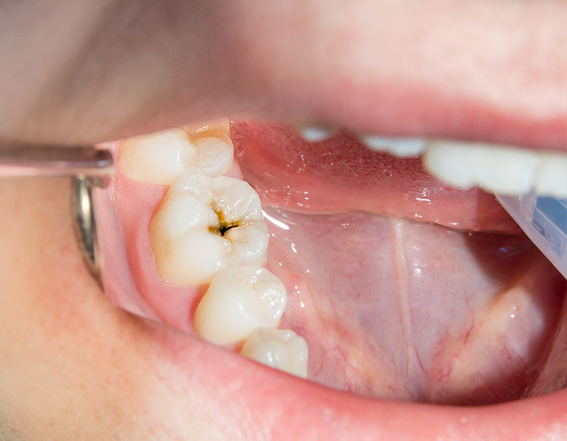Cavities and Dental Decay