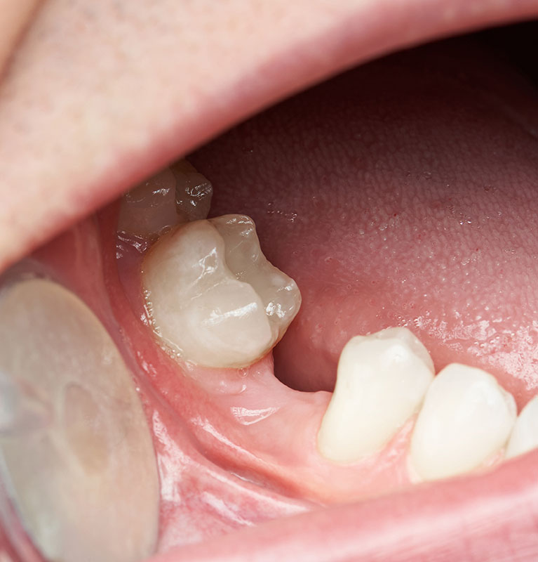 Help With Failing, Missing, or Knocked-Out Teeth