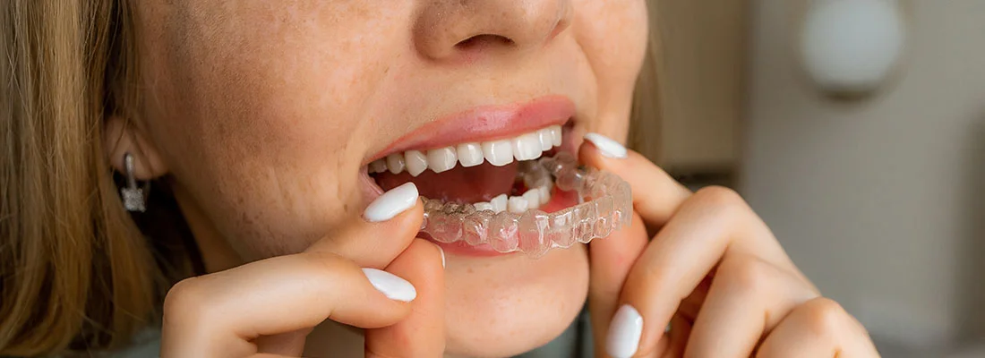 Comparison chart of Inman Aligner and traditional metal braces