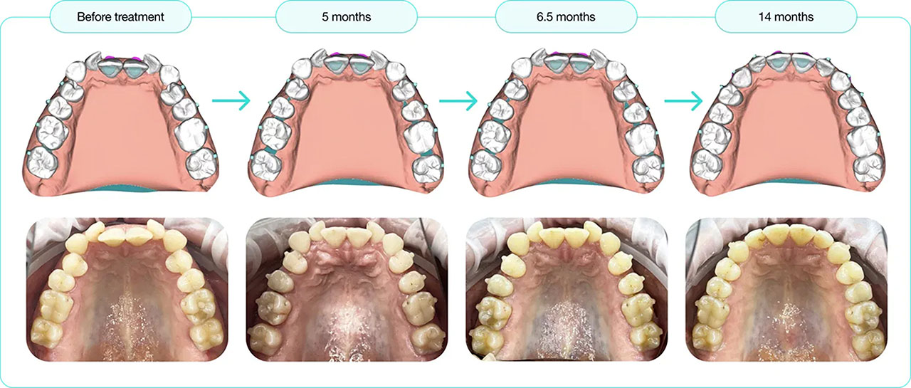 3D Predict Clear Aligners