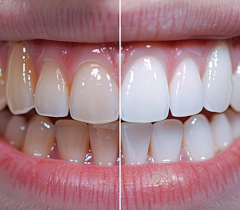 Patient receiving dental crown or bridge treatment in Deerfield Beach dental office